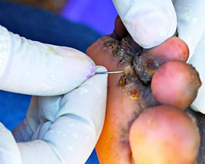 Jigger-disease-treatment Jigger-disease-medical-treatment