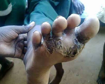 Jiggers-Disease-in-foot