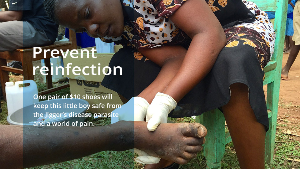 Jiggers-disease Working to combat Jiggers Disease