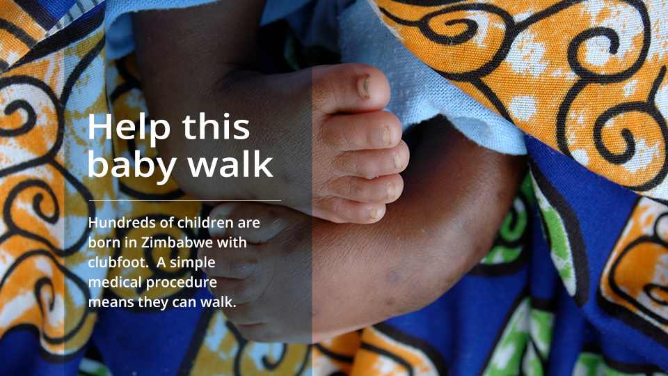 Baby-with-clubfoot Baby with clubfoot