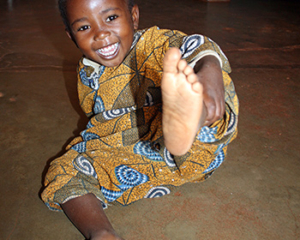 Happy-fixed-clubfoot Happy child with fixed clubfoot