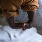 A little baby with clubfoot