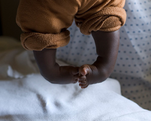 Showing-baby-with-clubfoot A little baby with clubfoot