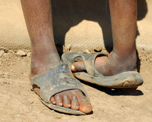 Untreated-clubfoot What happens when clubfoot is not treated